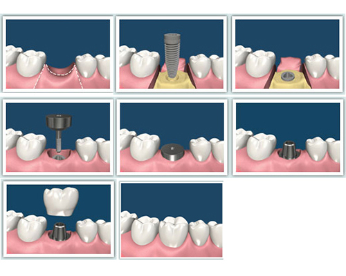 Dental Implants & Dentures